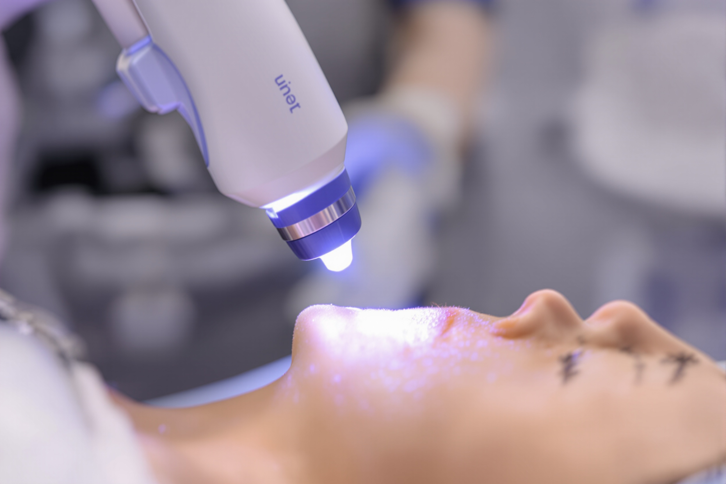 PicoLaser vs Laser Genesis for Pigmentation in Sydney